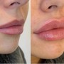 Lip Filler