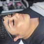 Microdermabrasion