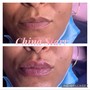 MicroNeedling