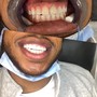 Full set 20 veneers