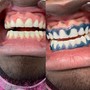 Top or bottom 6 teeth