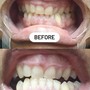 Teeth Whitening