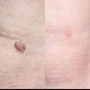 MicroNeedling