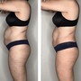 Body Slimming Laser Lipo