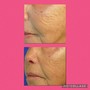 Dermaplaning Ageless stem Cel