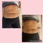 Body Slimming Laser Lipo