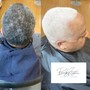 Alopecia Hair loss