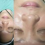 DERMAPLANING with LED