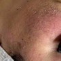 Microdermabrasion