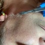 MicroNeedling