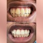 30 Minute Teeth Whitening