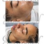 Dermaplaning