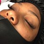 Microdermabrasion