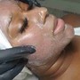 DERMAPLANING with LED