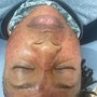 Microdermabrasion