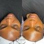 Deep Chemical peel