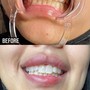 BB Upper/Lower Lip Package