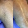 Underarm Sugaring