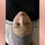 High Frequency Acne Treatment (Service add on)