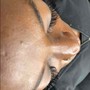 Hyperpigmentation/Dark Marks Chemical peel