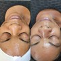 MicroNeedling