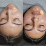 Acne Facial