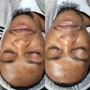 MicroNeedling