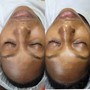 Microdermabrasion