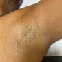 Ingrown Hair treatment