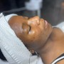 Microdermabrasion