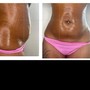 Skin Tightening/Cellulite Remover