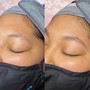 Lip Sugaring, Chin Sugaring