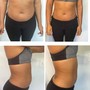 Laser Lipo Only- One Area