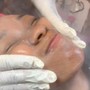 Chemical peel