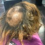 Scalp Treatment