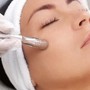 Microdermabrasion