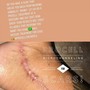 Scar Resurfacing Treatment