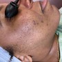 Microdermabrasion