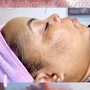 Dermaplaning Facial