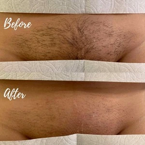 Brazilian Wax Pictures Before And After Female