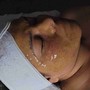 Microneedling Facial