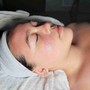 Microneedling Facial