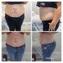 Laser lipo/chin laser  lipo /arm laser lipo