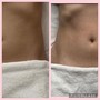 Body Slimming Laser Lipo