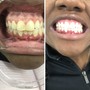 Teeth Whitening