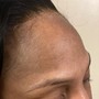 Scalp Treatment