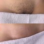 Brazilian Wax, Vajacial