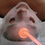 Body RF Treatment