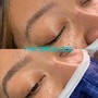 MicroNeedling