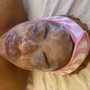 Acne Facial